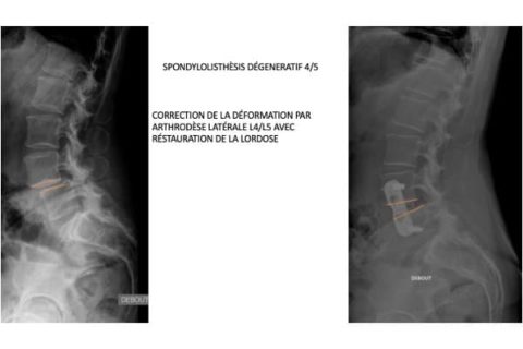 Spondylolisth Sis D G N Ratif Institut Du Rachis Paris