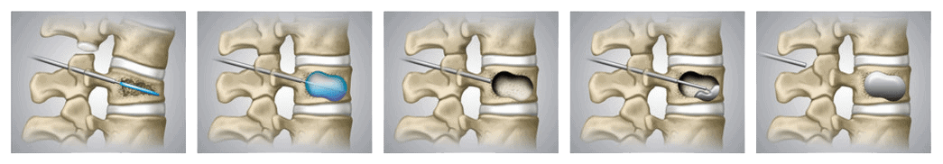 cimentoplastie vertebrale cimentoplastie lombaire cimentoplastie effets secondaires institut du rachis parisien