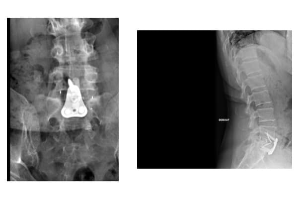 arthrodese anterieure cure hernie discale ambulatoire institut du rachis paris chirurgien du rachis specialiste dos paris