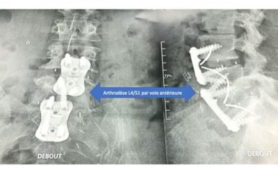 arthrodese l4s1 anterieure voie anterieure institut du rachis paris chirurgien du rachis specialiste dos paris