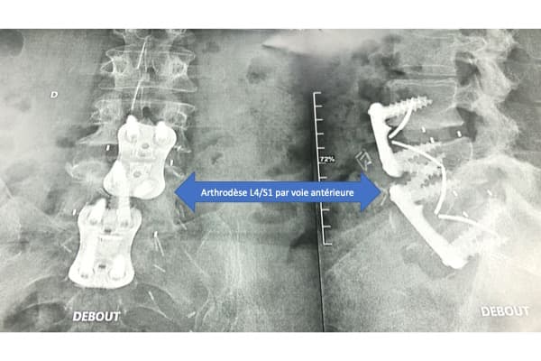 arthrodese l4s1 anterieure voie anterieure institut du rachis paris chirurgien du rachis specialiste dos paris