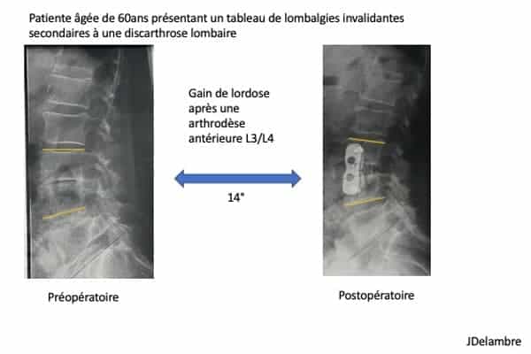 arthrodese lombaire l3l4 voie anterieure institut du rachis paris chirurgien du rachis specialiste dos paris