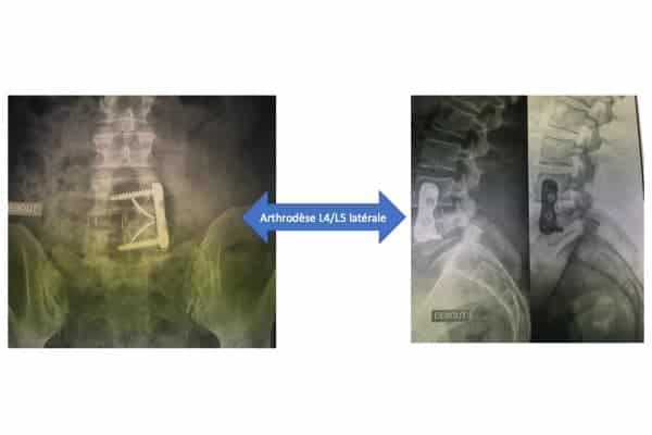 athrodese lombaire l4 l5 laterale voie anterieure institut du rachis paris chirurgien du rachis specialiste dos paris