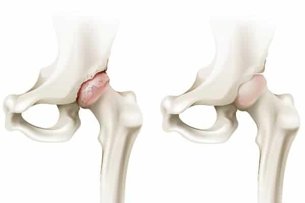 coxarthrose arthrose hanche paris arthrose hanche traitement institut du rachis paris chirurgien du rachis specialiste dos paris