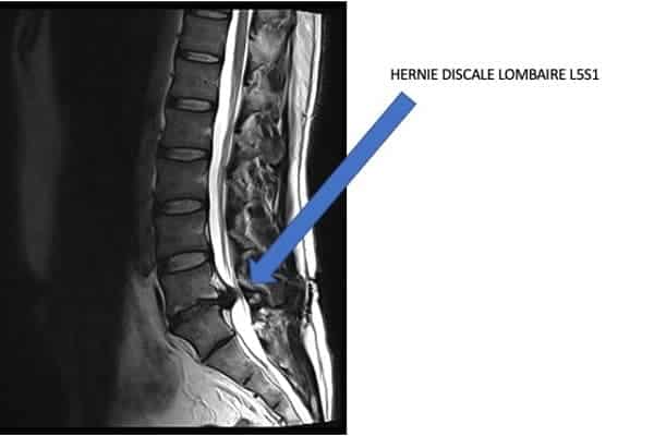 hernie discale lombaire l5s1 chirurgien specialiste rachis dos paris dr delambre pr poignard dr arvieu dr queinnec pr allain institut rachis paris