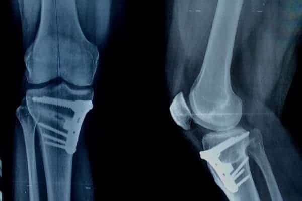 osteotomie tibiale valgisation chirurgie arthrose genou institut du rachis parisien dr jerome delambre professeur alexandre poignard