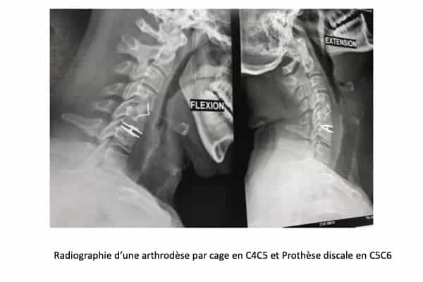 prothese discale cervicale arthrodese cervicale c5c6 voie anterieure institut du rachis paris chirurgien du rachis specialiste dos paris