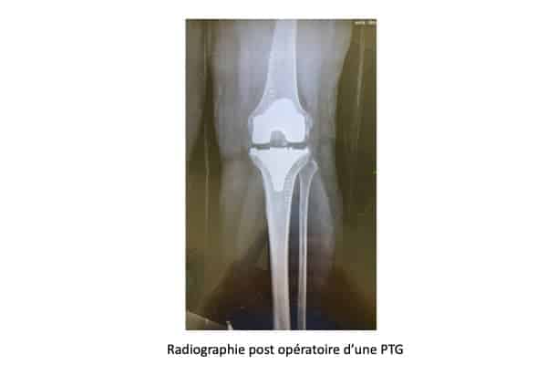 prothese genou prothese totale genou operation institut du rachis paris chirurgien du rachis specialiste dos paris