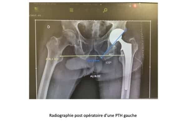prothese hanche paris prothese hanche operation institut du rachis paris chirurgien du rachis specialiste dos paris