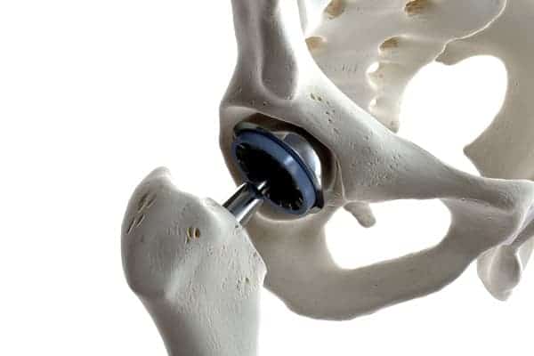 prothese hanche paris prothese totale hanche chirurgie hanche paris institut du rachis parisien dr jerome delambre professeur alexandre poignard