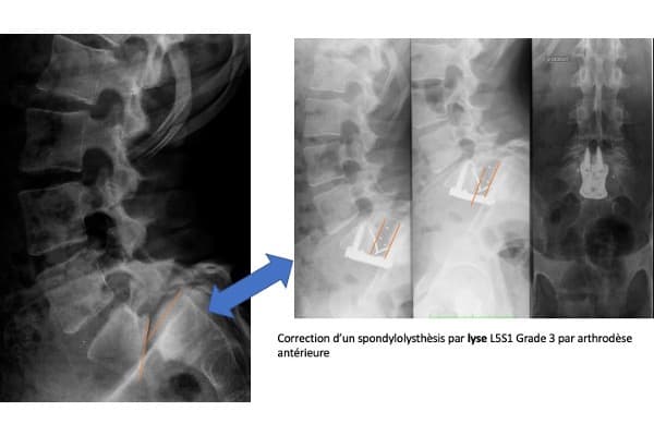 spondylolisthesis par lyse isthmique traitement que faire chirurgien specialiste rachis dos paris dr delambre pr poignard dr arvieu dr queinnec pr allain institut rachis paris