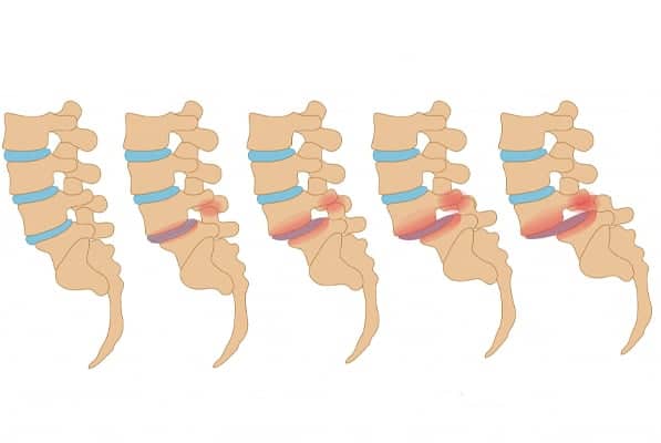 spondylolisthesis paris spondylolisthesis degeneratif glissement vertebre glissement de vertebre traitement institut rachis paris chirurgien specialiste dos paris