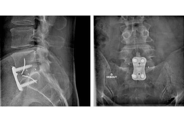 arthrodese lombaire anterieure operation chirurgie voie anterieure chirurgien dos paris specialiste rachis paris institut rachis parisien