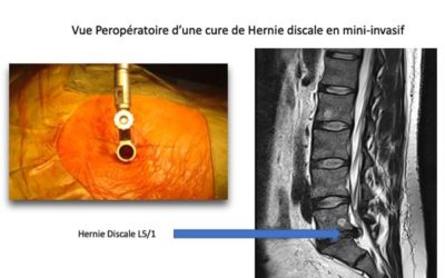 La cure de hernie discale mini invasive