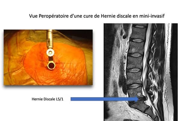 phophoto hd mini chirurgie mini invasive hernie discale hernie discale operation institut du rachis paris chirurgien du rachis specialiste dos paristo hd mini institut du rachis paris chirurgien du rachis specialiste dos paris