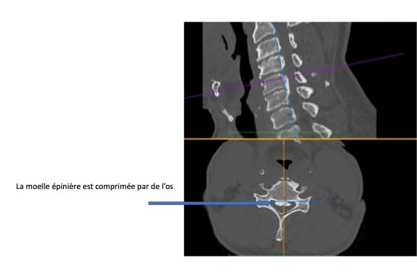 myelopathie cervicale arthrosique moelle epiniere os arthrose chirurgien rachis paris chirurgien dos institut rachis paris