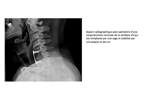 myelopathie cervicale arthrosique radio post operatoire corporectomie cervicale v6 arthrose chirurgien rachis paris chirurgien dos institut rachis paris