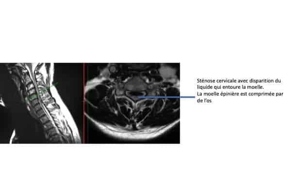 myelopathie cervicale arthrosique stenose cervicale arthrose chirurgien rachis paris chirurgien dos institut rachis paris