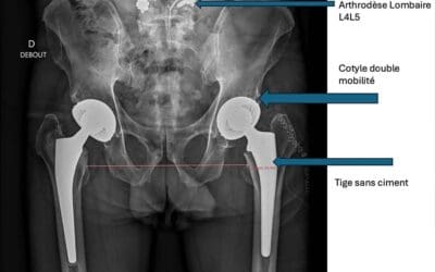 Prothèse totale de hanche après arthrodèse lombaire : tout savoir
