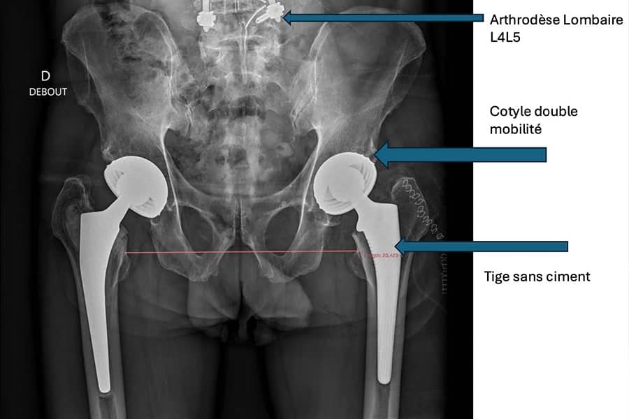 prothese totale de hanche apres arthrodese lombaire institut du rachis parisien chirurgien orthopediste specialiste du rachis et du dos